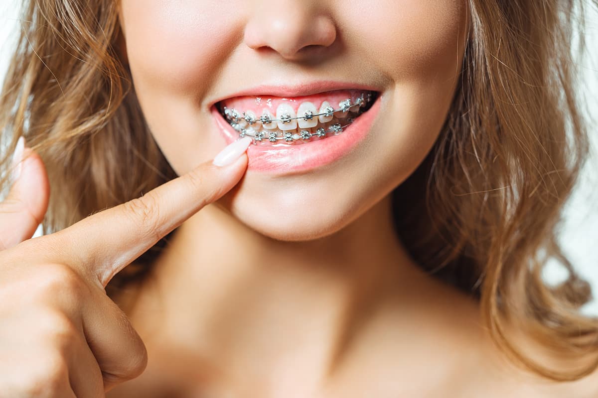 Why Should Adults Consider Getting Braces?
